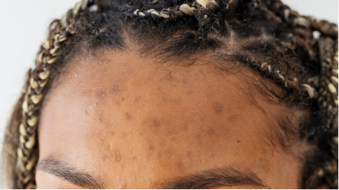 AVAVA Receives FDA Clearance for Acne Scar Treatment on All Skin Types Using Focal Point Technology