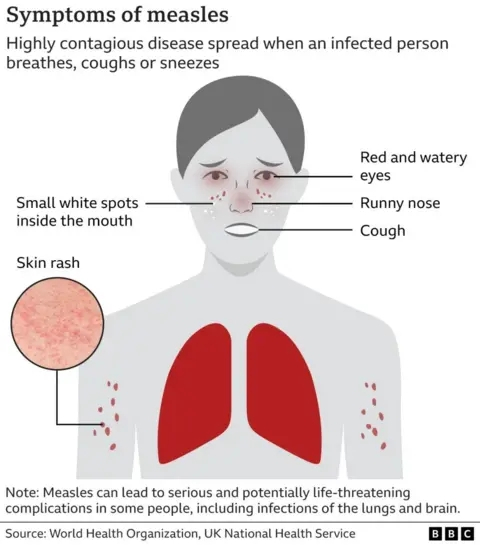 Measles holiday warning as cases rise in Europe