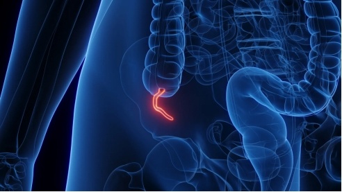 Appendix Cancer Has Quadrupled in Millennials