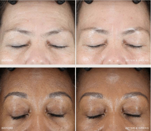 iS Clinical Executives Explain Impact of New Peel System